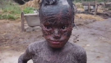 VIDEO: Chlapec (10) trpí vzácnou mutáciou. Jeho koža rýchlo schne a zhadzuje sa