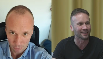 Roman podstúpil vlasovú transplantáciu. Popísal, ako to celé prebiehalo