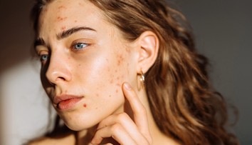 Šíri sa návod, ako sa zázračne zbavíte akné. Dermatologička vysvetľuje, prečo je to hrozný nápad