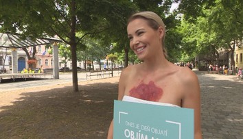 Niektorí sa jej stále boja. Pozrite si reakcie Slovákov na figurantku so psoriázou