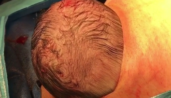 Fascinujúce zábery cisárskeho rezu. Dieťa sa samé predralo na svet