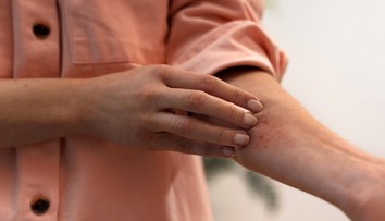 Kožná forma celiakie. Durhingova choroba sa prejavuje vyrážkami podobnými herpesu