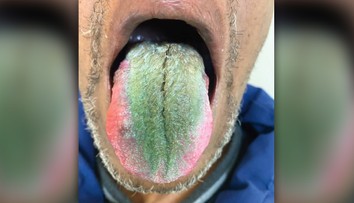 Lekári opísali bizarný prípad: Mužovi sa na jazyku vytvoril zelený povlak pripomínajúci srsť
