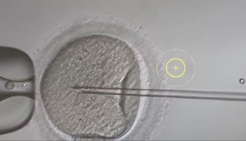 Dávajú nádej párom, ktoré majú problém počať dieťa. Ako vyzerá proces darovania vajíčok?