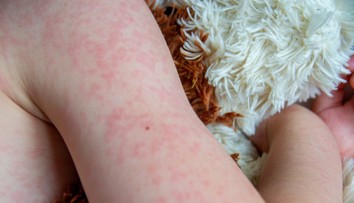 Osýpky nie sú banálne ochorenie. Pre jednu skupinu pacientov môže byť fatálne