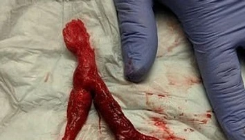 Muž sa sťažoval na bolesť chrbta a nevoľnosť: V pľúcach mu našli obrovskú zrazeninu