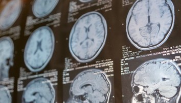 Vedci tvrdia, že vedia, prečo ľudia so schizofréniou „počujú hlasy“