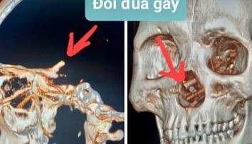 Muž žil mesiace s bolesťami hlavy. Keď si lekári pozreli CT snímku, neveriacky si pretierali oči