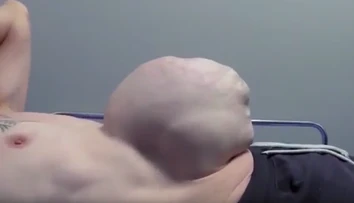Musel žiť s obrovským pruhom. Bol veľký ako futbalová lopta