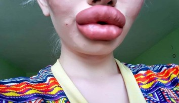 Dievča chcelo byť viac trendy. Dnes má také veľké pery, že ich nevie spojiť