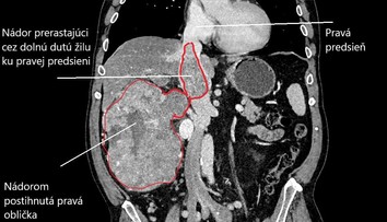 FOTO: V Rooseveltovej nemocnici vyoperovali nádor veľkosti rugbyovej lopty