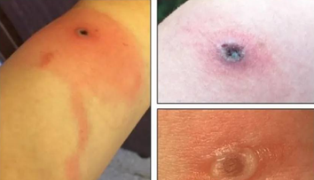 Nové vírusové ochorenie má prvú obeť. Všetko sa zrejme začalo škrabancom od mačky