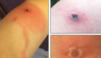 Nové vírusové ochorenie má prvú obeť. Všetko sa zrejme začalo škrabancom od mačky