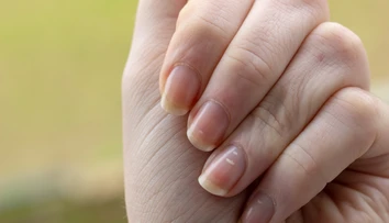 Biele škvrny či ryhy na nechtoch. Môžu poukazovať na nedostatok vitamínov, ale aj vážne ochorenia