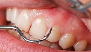 Nemecký zubár vytiahol najdlhší ľudský zub na svete