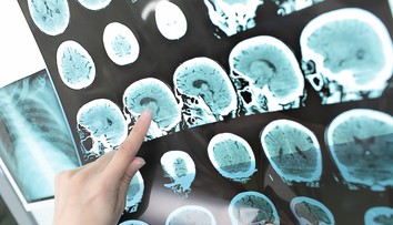 Vedci odhalili pravdepodobnú príčinu sklerózy multiplex. Spôsobuje ju bežný vírus