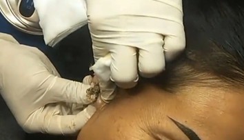 VIDEO: Lekár neveril vlastným očiam. Nenápadná vyrážka takmer poškodila žene ucho