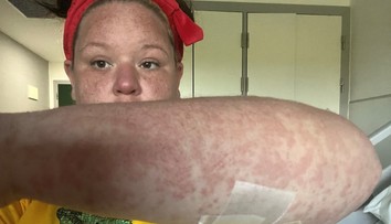 Ženu bodol na dovolenke nebezpečný hmyz. V reakcii s antibiotikami jej opadávali koža, vlasy aj nechty