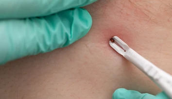 Na Slovensku tento rok evidujú vyše 180 prípadov kliešťovej encefalitídy. Riziko nepodceňujte ani na jeseň