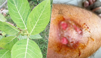 Vážne popáleniny mu spôsobila miazga zo známeho kríka. Pán Martin varuje aj ostatných záhradkárov