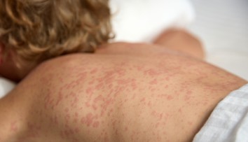 Na východe Slovenska potvrdili tri prípady osýpok