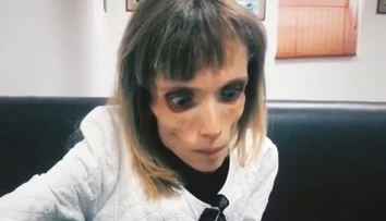 Anorektička (26) vyzerá ako z hororu. Váži iba 17 kilogramov