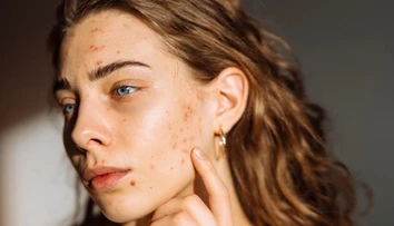 Šíri sa návod, ako sa zázračne zbavíte akné. Dermatologička vysvetľuje, prečo je to hrozný nápad
