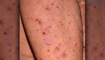 Byty na Orechovom dvore v Nitre musia vyplynovať. Rozmnožili sa tu ploštice a svrab