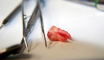 Sťažoval sa na "plný nos" a zlé dýchanie. Vyšetrenie odhalilo v dutine zaklieštený zub