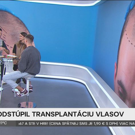 Martin Koči rozprával v Teleráne o transplantácii vlasov.