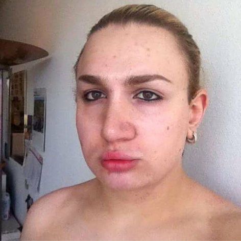 Ivana Vladislava pred odstránením silikónu.