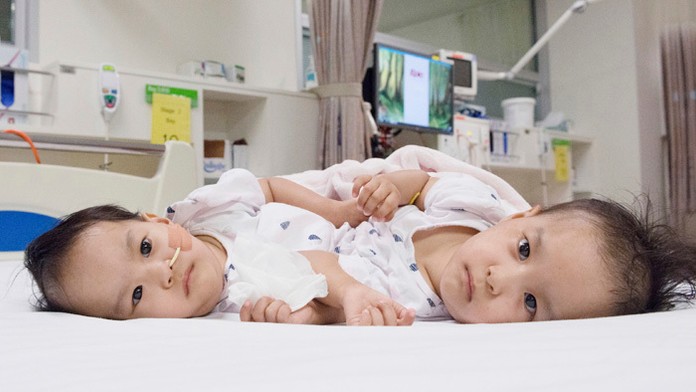 Austrálski chirurgovia úspešne oddelili 15-mesačné siamské dvojčatá Nimu a Dawu Paldenové.