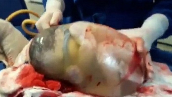 Nezvyčajný pôrod. 