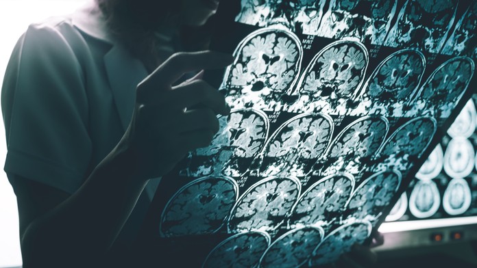 Alzheimerova choroba 