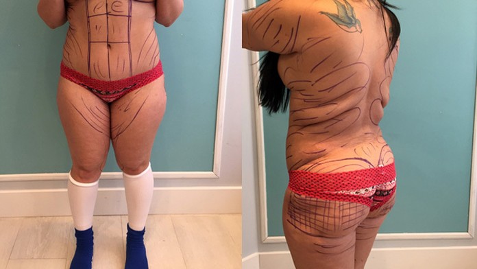 liposukcia.jpg