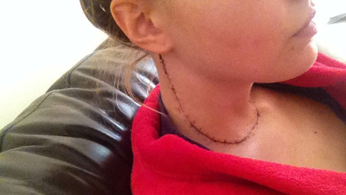 Bývalá miss Clemmie Huckerby má rakovinu