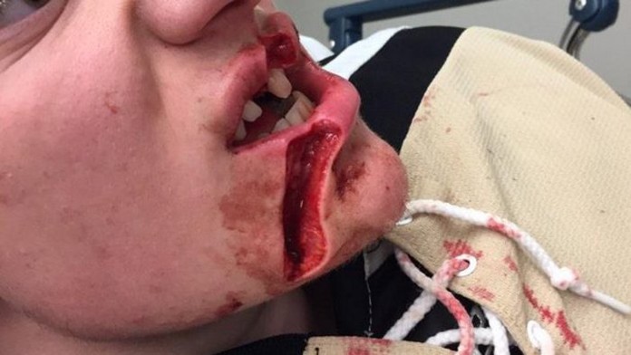 Hrozivé zranenie brankára DJ Lamartina.