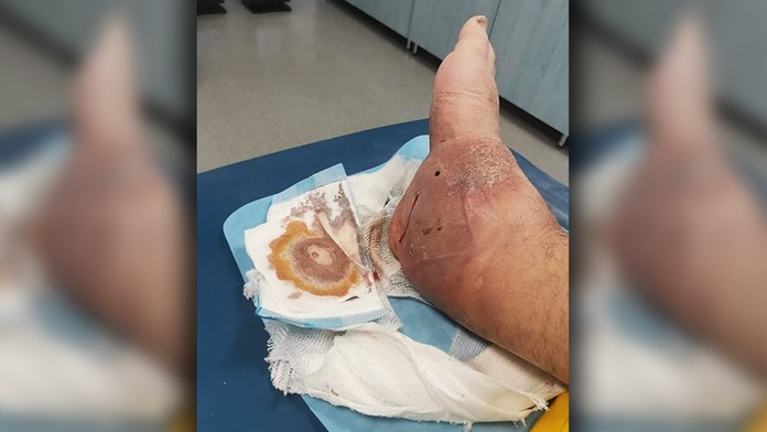 Petrovi po zranení opuchla noha a dostal otravu krvi.