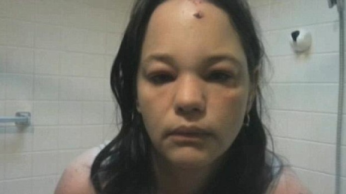 Útok spôsobil žene masívne opuchy. 