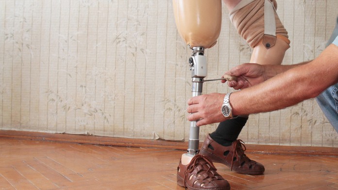 Protéza - ilustračná foto