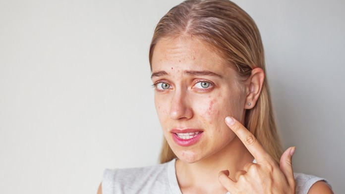 Zlá pleť (ilustračná snímka)