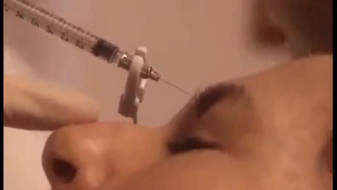 Botulotoxín využívajú v estetickej medicíne