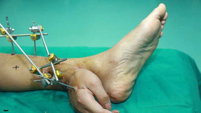 Číňanovi prišili ruku o členok