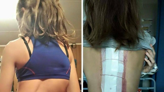 Sam Hansen a jej chrbtica predtým a teraz.