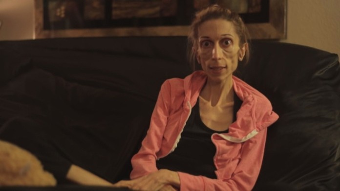 Anorektička Rachel.