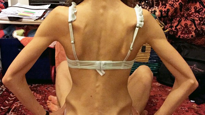 Margherita Barbieri bojovala s anorexiou.