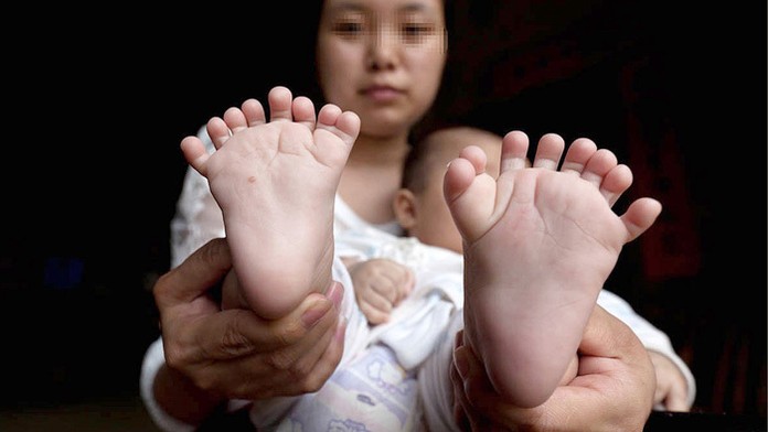 V Číne sa narodil chlapec, ktorý má 31 prstov.