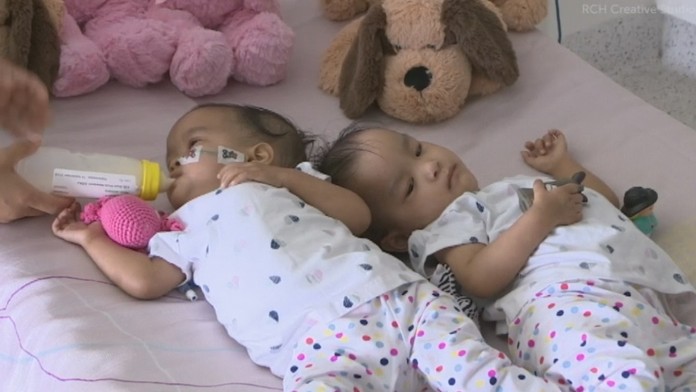 Siamské dvojčatá z Bhutánu 