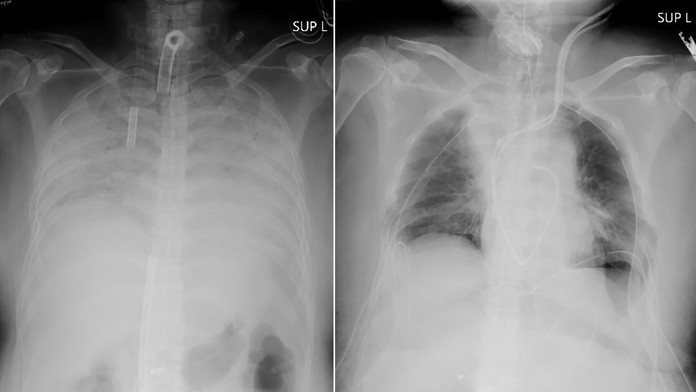Pľúca pacientky pred transplantáciou a po nej