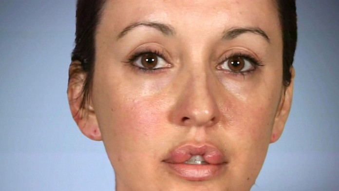 Keara chcela mať pery ako Angelina Jolie.  